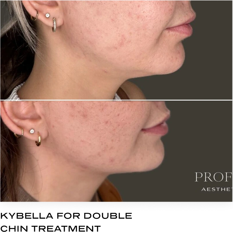 Side-by-side before and after comparison showing a person's chin and jawline for Kybella treatment