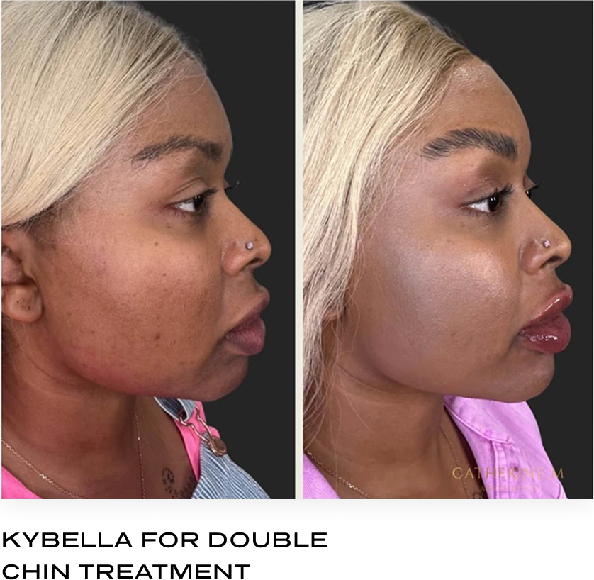 Side-by-side profile comparison showing reduced under-chin fullness after Kybella treatment
