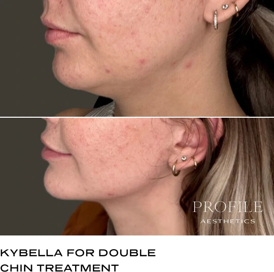 Before-and-after profile comparison showing double chin reduction from Kybella treatment