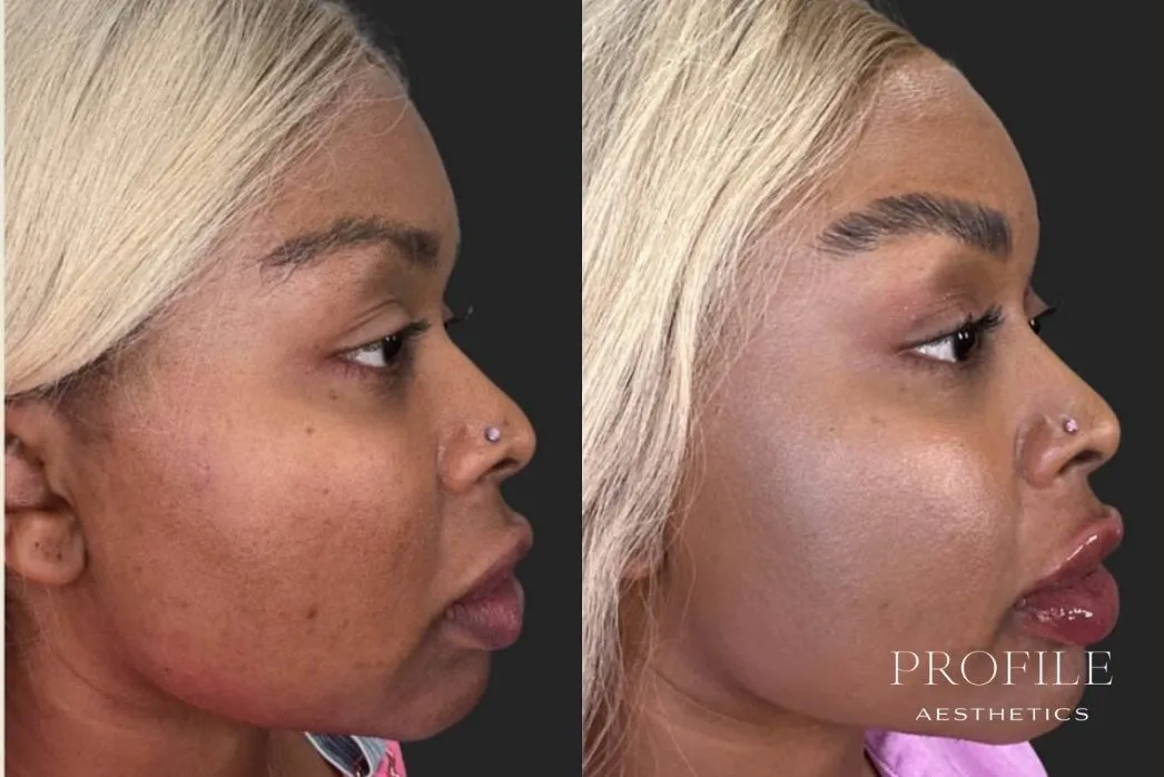 Before and after side profile showing reduced under-chin fullness