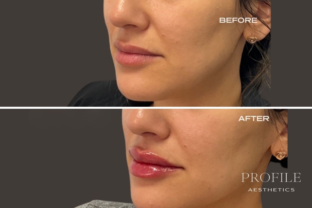 Lip Filler (3)