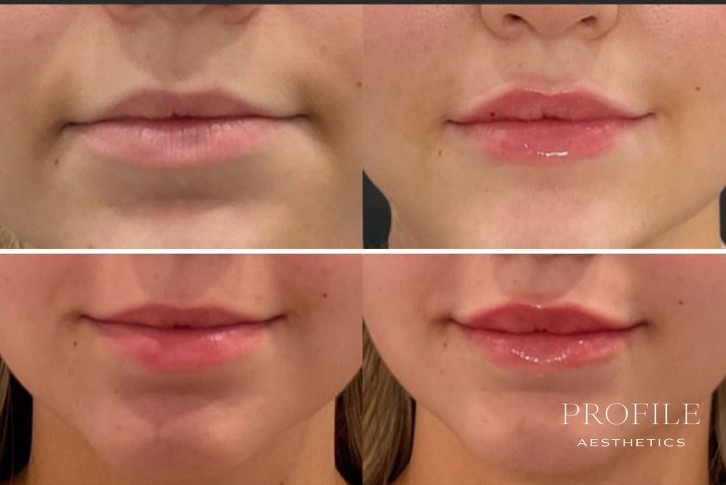 Lip Filler (4)
