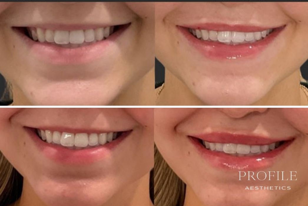 Lip Filler (6)