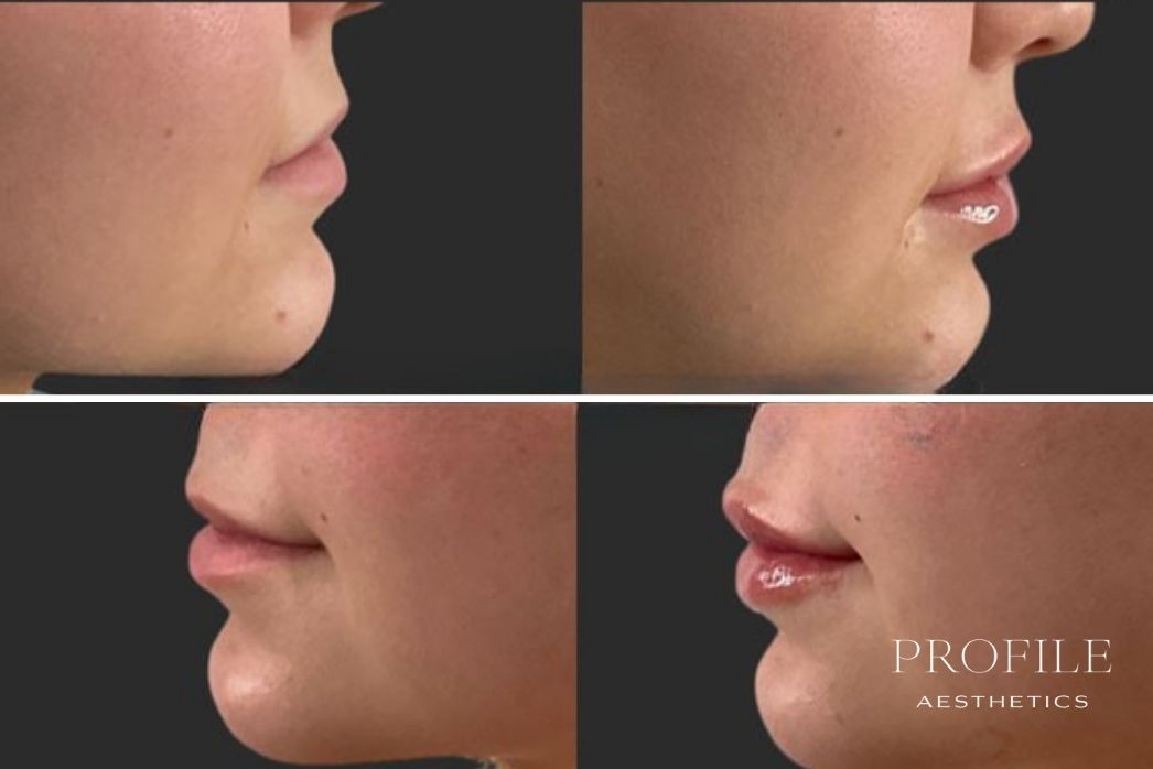 Lip Filler (8)