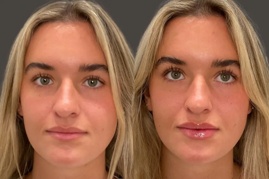 Before and after lip filler treatment showing fuller lips on patient's right side