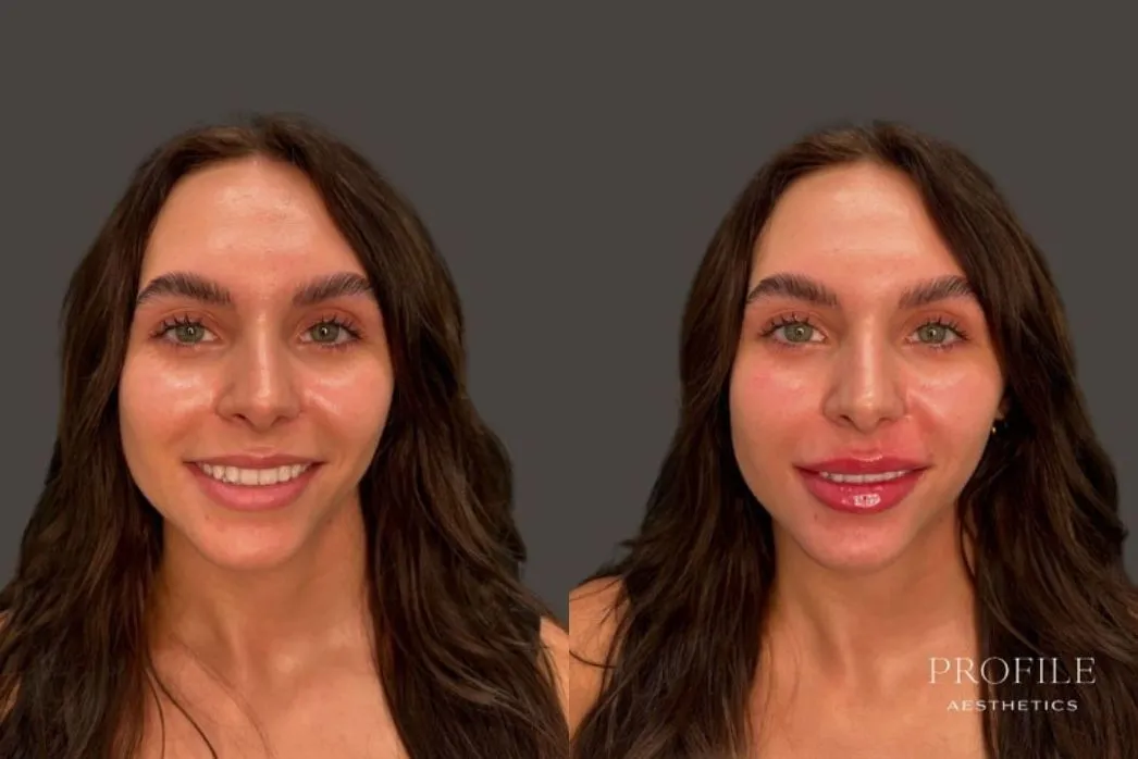 Before and after frontal view showing fuller, more defined lips