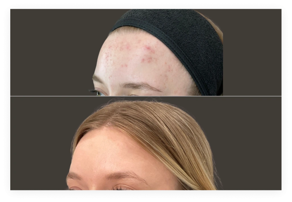 Before and after microneedling showing forehead and eyebrow area with smoother, clearer skin
