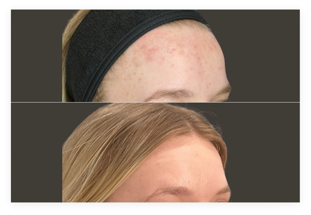 Before and after microneedling displaying forehead and brow with diminished acne and refined skin tone