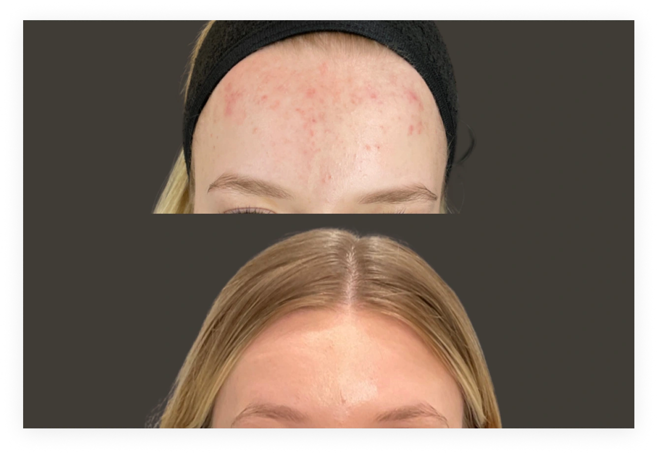 Before and after microneedling treatment showing forehead with reduced redness and improved skin texture