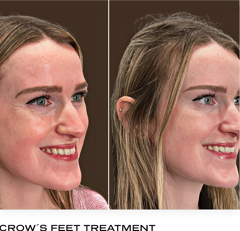 Crow's feet treatment before and after, profile view showing reduced eye wrinkles