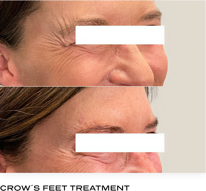 Crow's feet treatment before and after, side profile showing reduced eye wrinkles