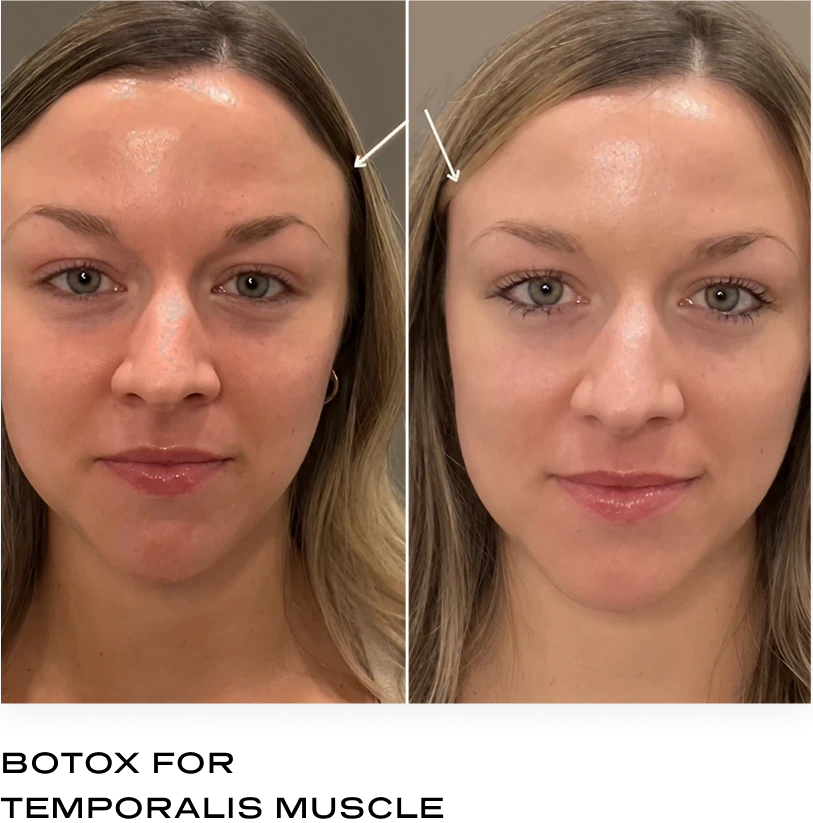 Botox for temporalis muscle before and after, frontal view showing smoother forehead