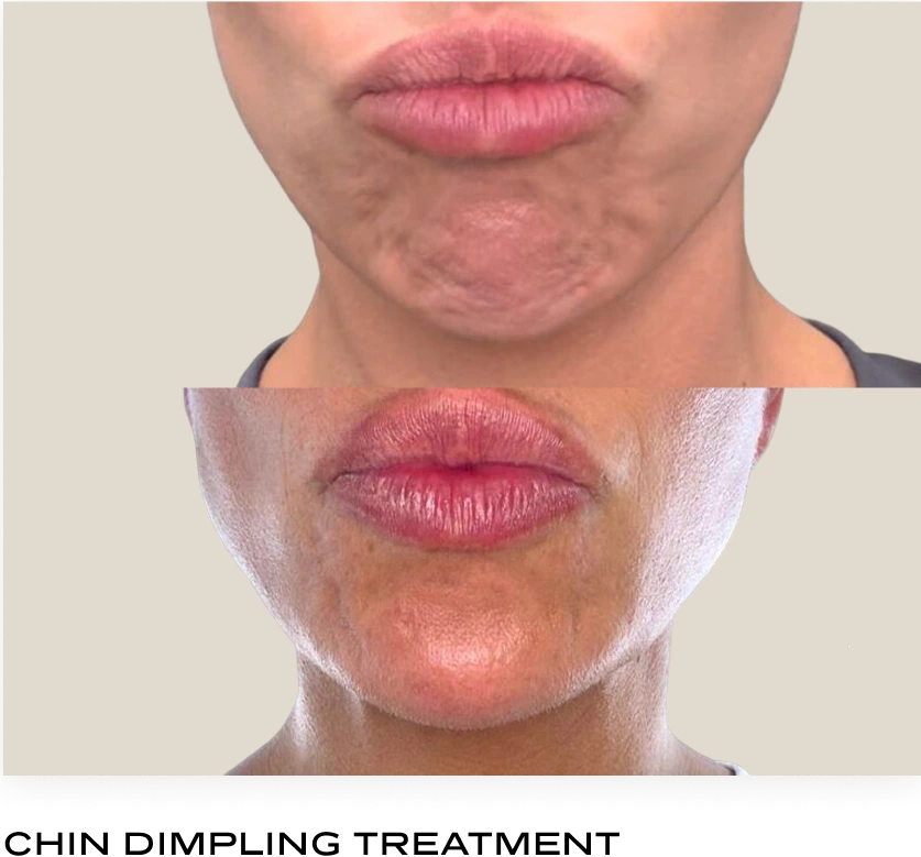 Before and after chin showing reduced dimpling after neurotoxin treatment