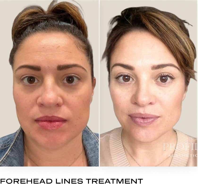 Before and after forehead showing reduced lines after neurotoxin treatment