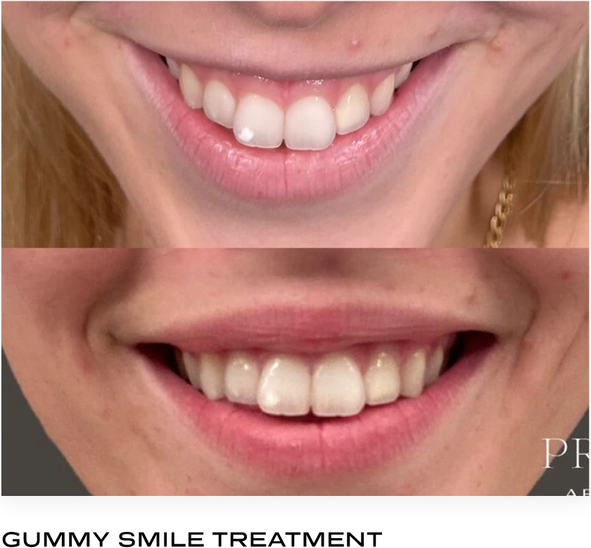 Before and after smile showing gum line reduction after gummy smile treatment