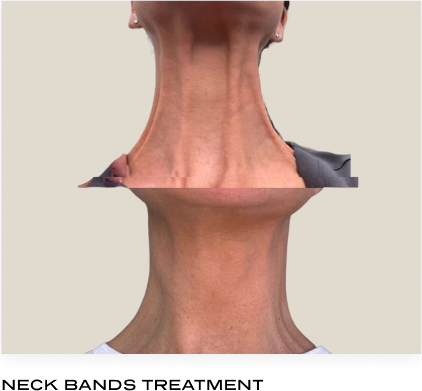 Before and after neck showing reduced visible bands after neurotoxin treatment