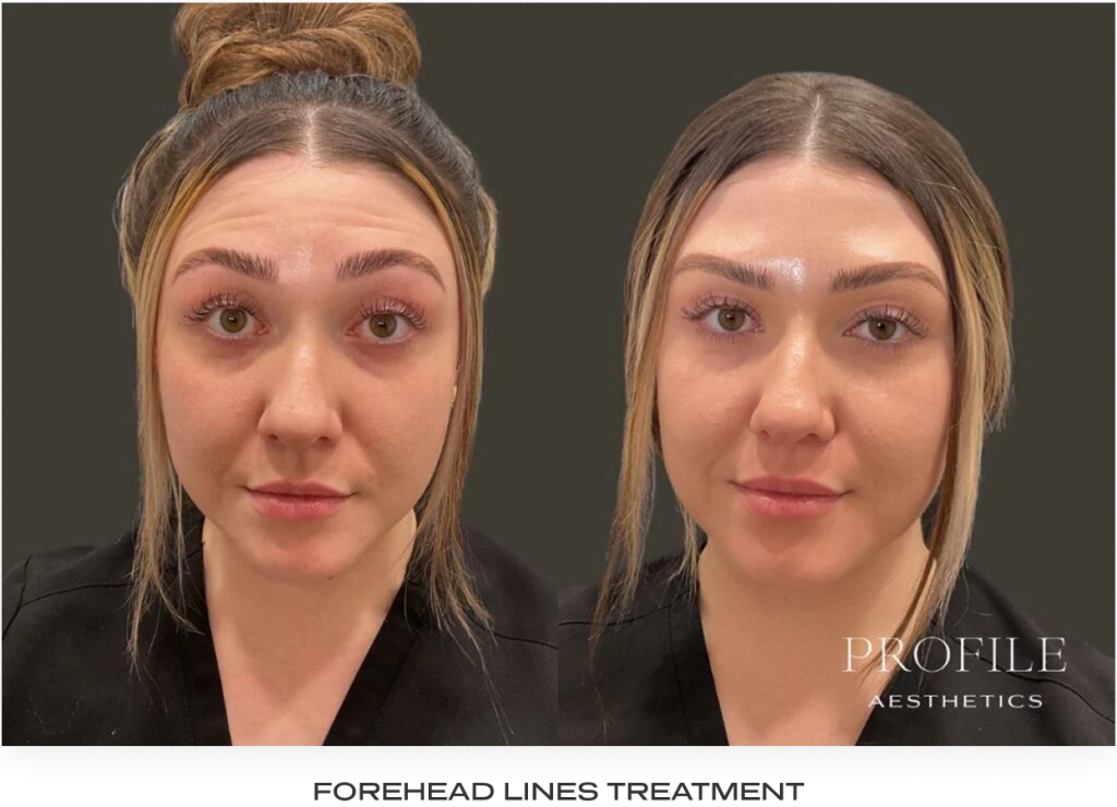 Before and after frontal view showing forehead lines treatment results