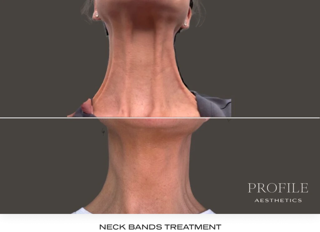 Before and after neck comparison showing reduced neck bands after neurotoxin treatment