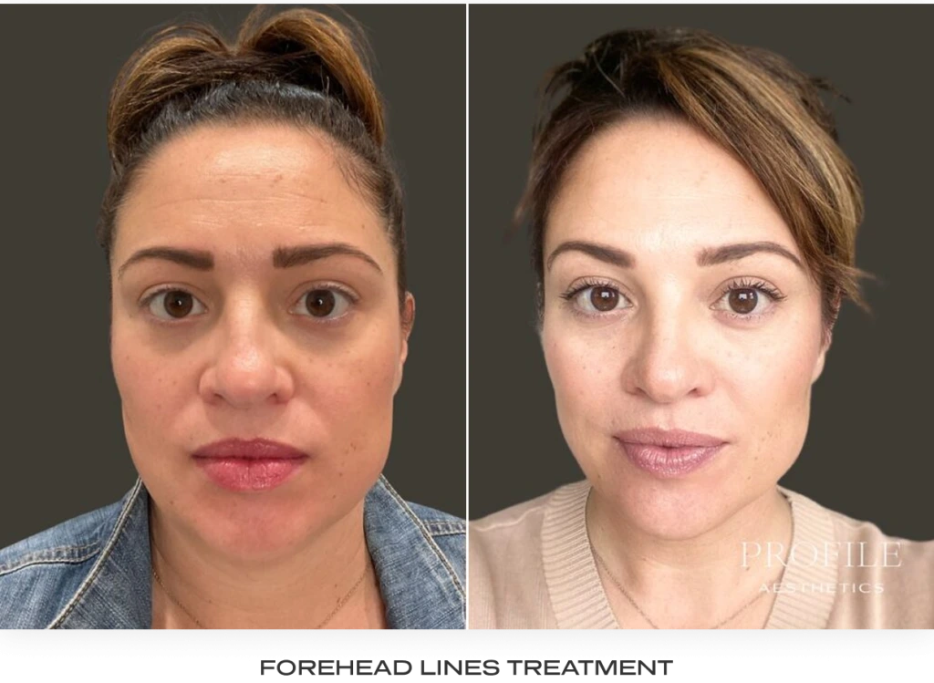 Before and after facial comparison showing reduced forehead lines after neurotoxin treatment