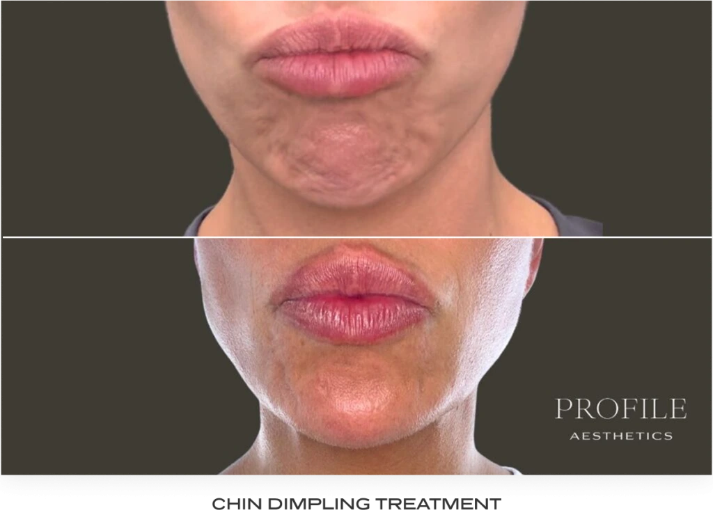 Before and after lower face comparison showing reduced chin dimpling after neurotoxin treatment