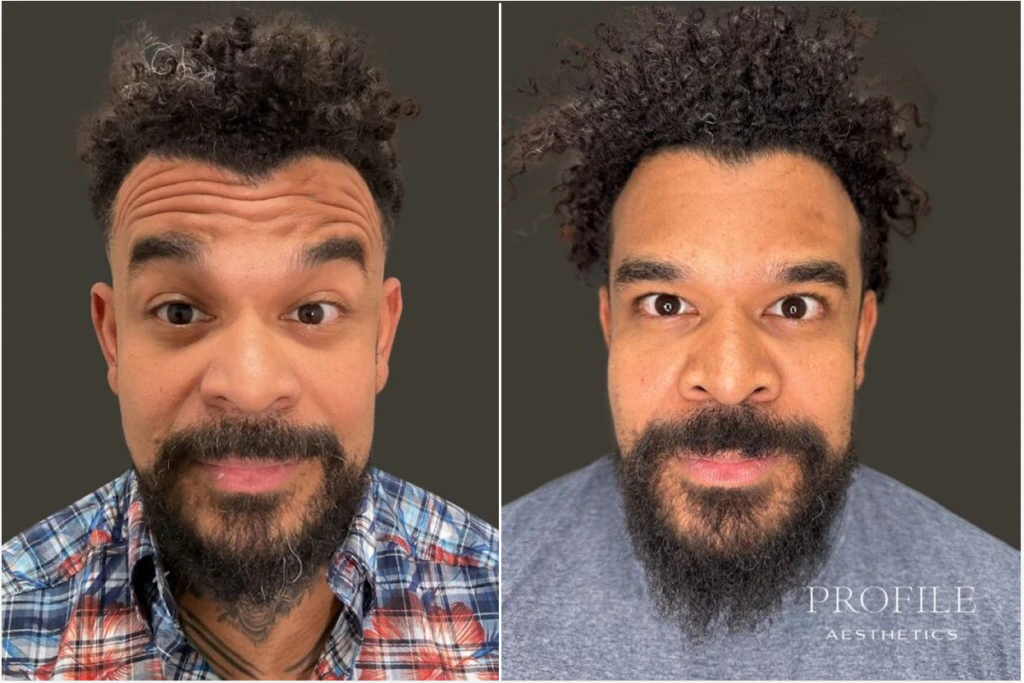 Before and after comparison of man's face showing reduced forehead wrinkles