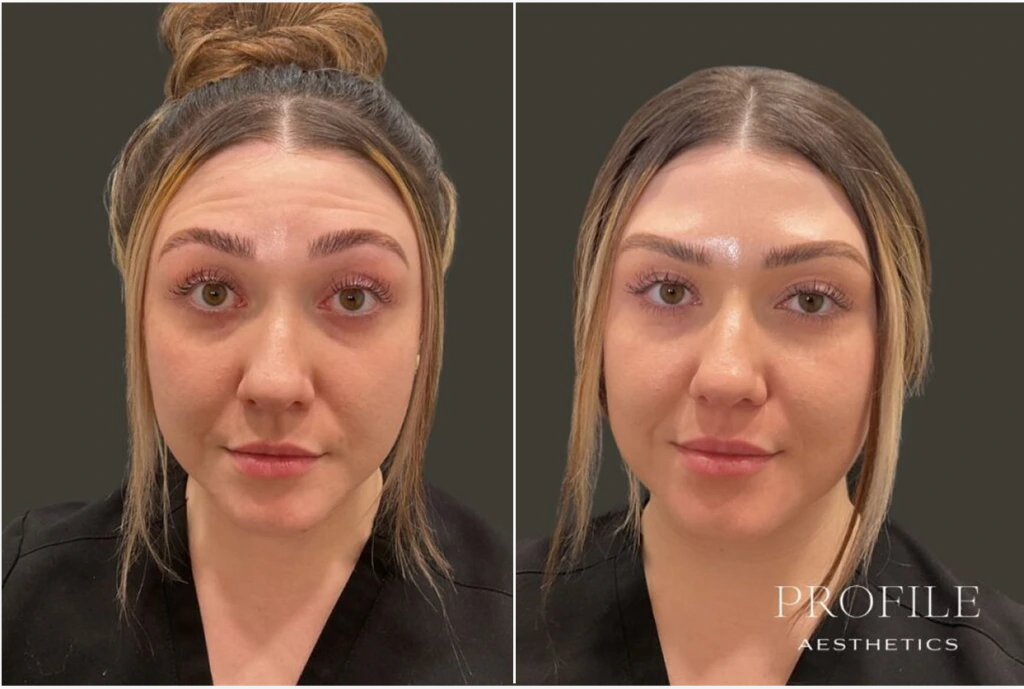 Before and after comparison of woman's face showing reduced forehead lines and smoother skin