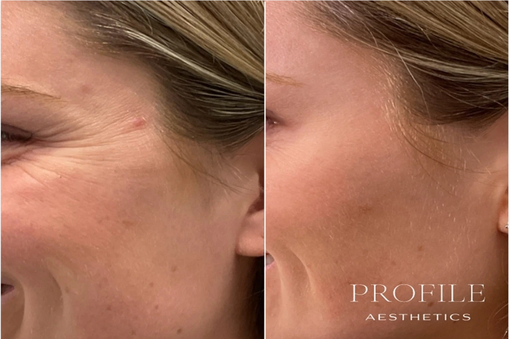 Before and after close-up comparison of woman's temple area showing reduced crow's feet wrinkles