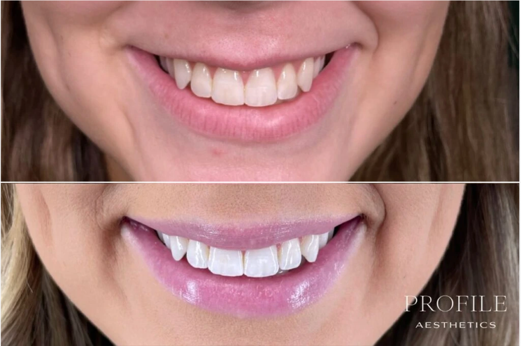 Before and after comparison of smile with fuller, more defined lips