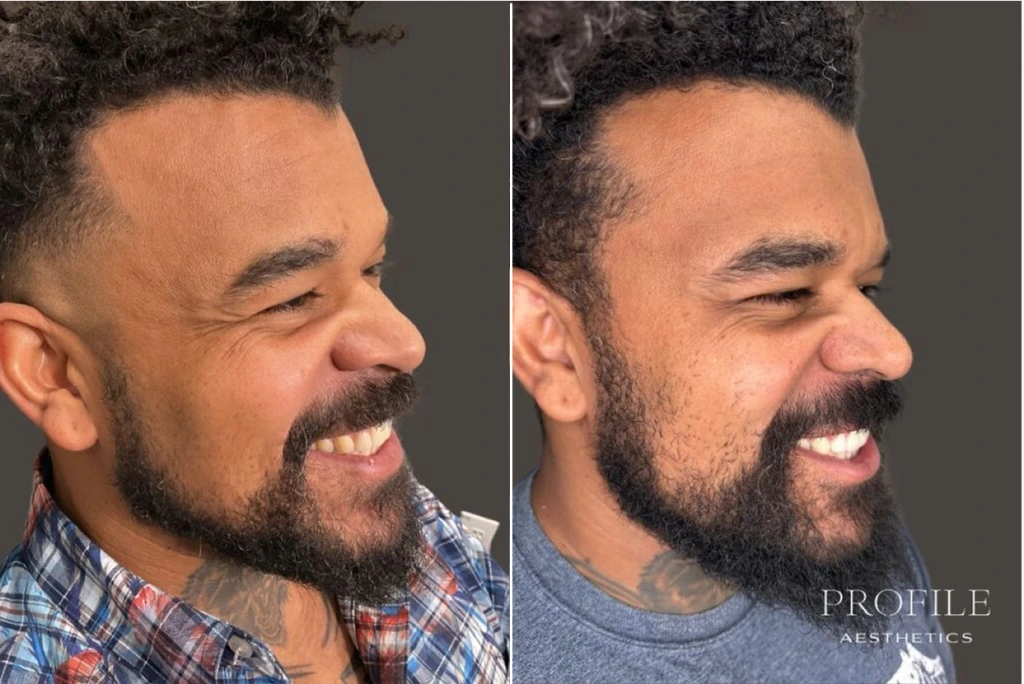 Before and after side profile showing reduced forehead wrinkles and smoother skin