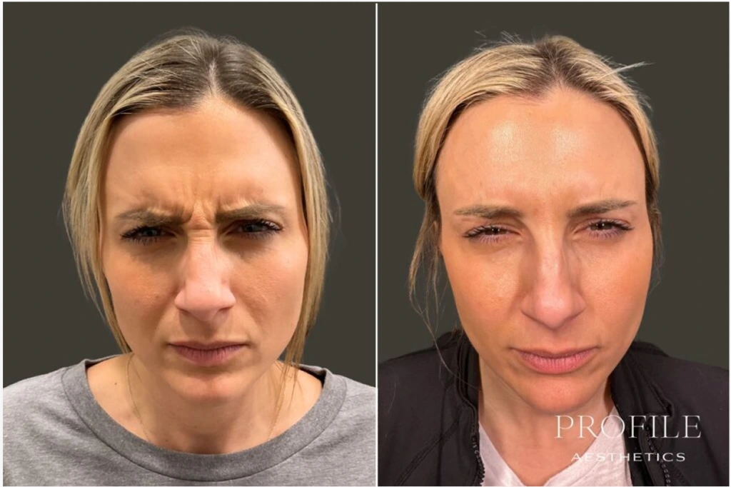 Before and after front view showing softened frown lines between eyebrows