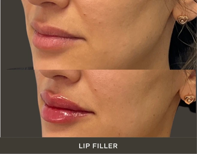 Woman's lips before and after lip filler treatment, showing increased fullness