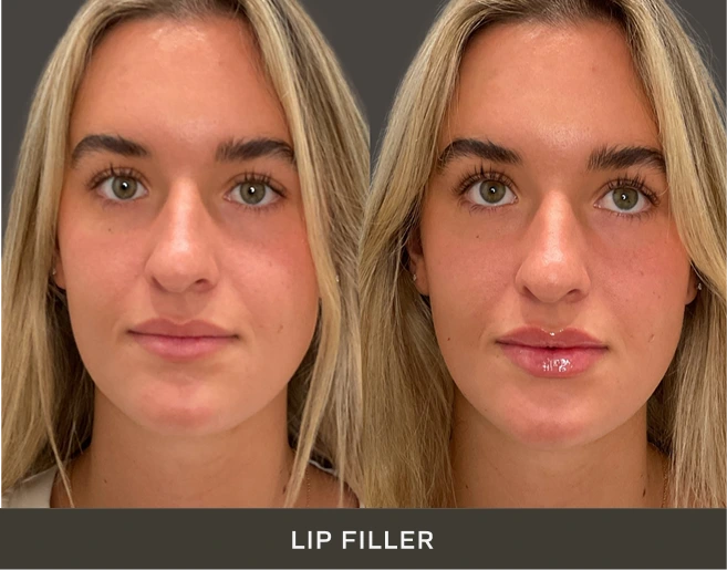 Woman's face before and after lip filler treatment, showing enhanced lip volume