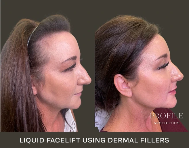 Woman in profile before and after liquid facelift with dermal fillers, showing improved facial contours