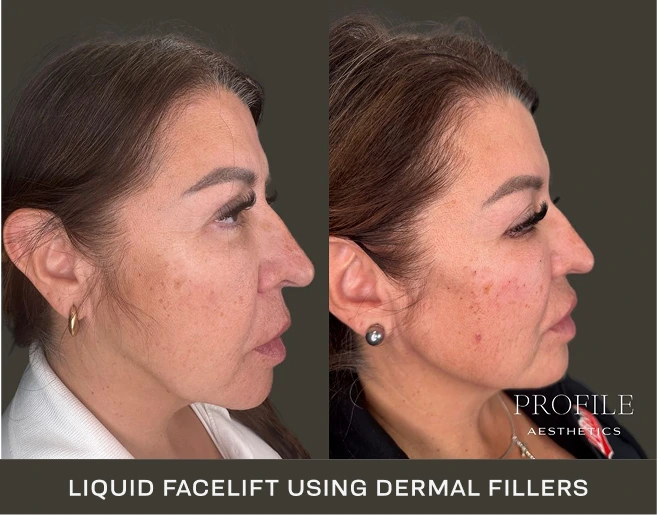 Woman in profile before and after liquid facelift with dermal fillers, showing refined facial definition