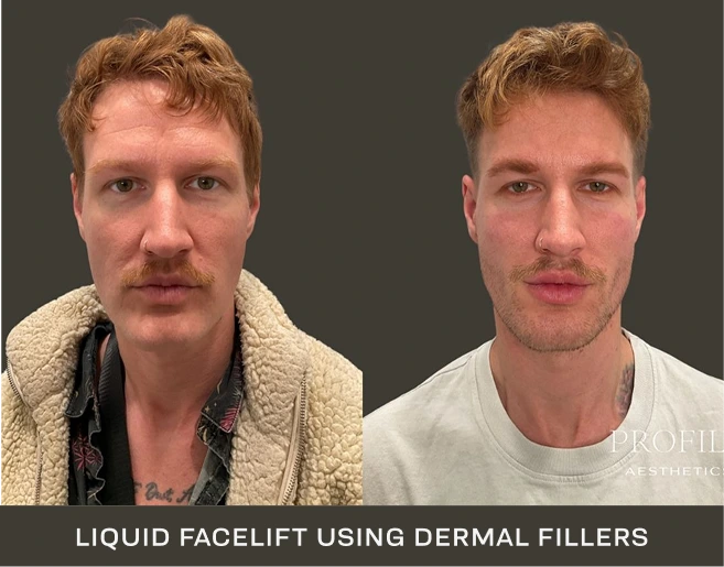Before and after liquid facelift with dermal fillers showing enhanced facial structure and volume