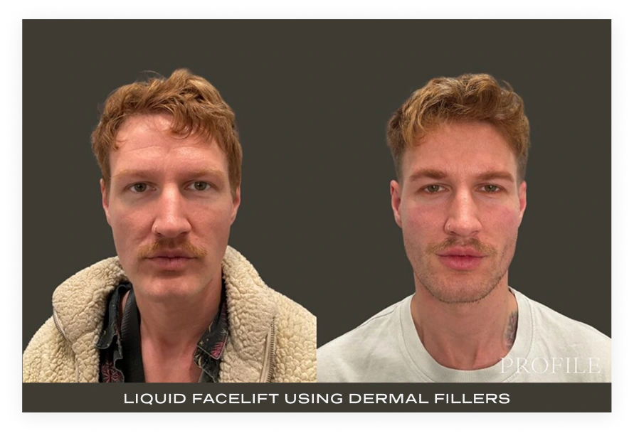 Before and after frontal headshots showing liquid facelift results with dermal fillers
