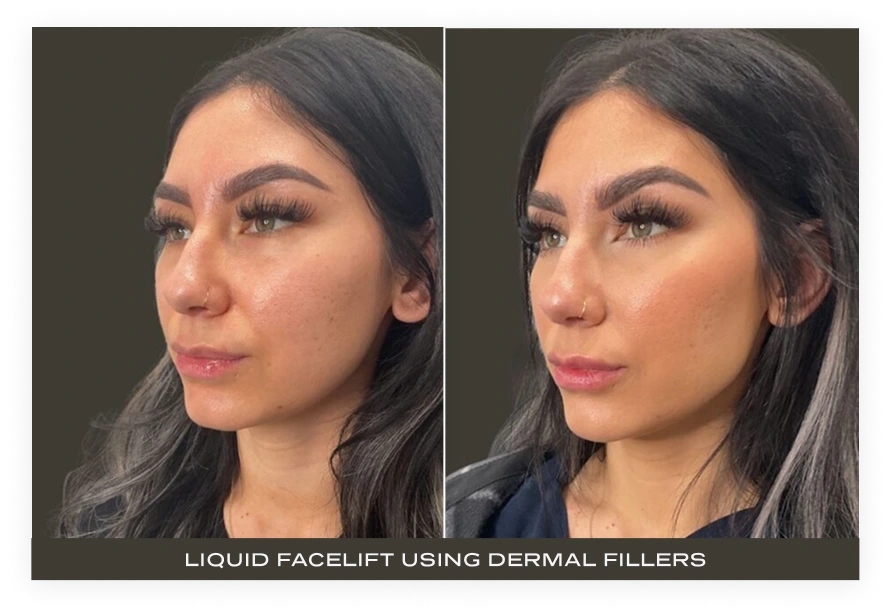 Before and after side-profile comparison showing liquid facelift results with dermal fillers