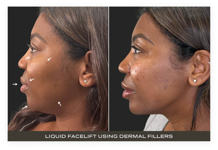 Before and after side-profile comparison showing liquid facelift results with dermal fillers, with arrows indicating treatment areas