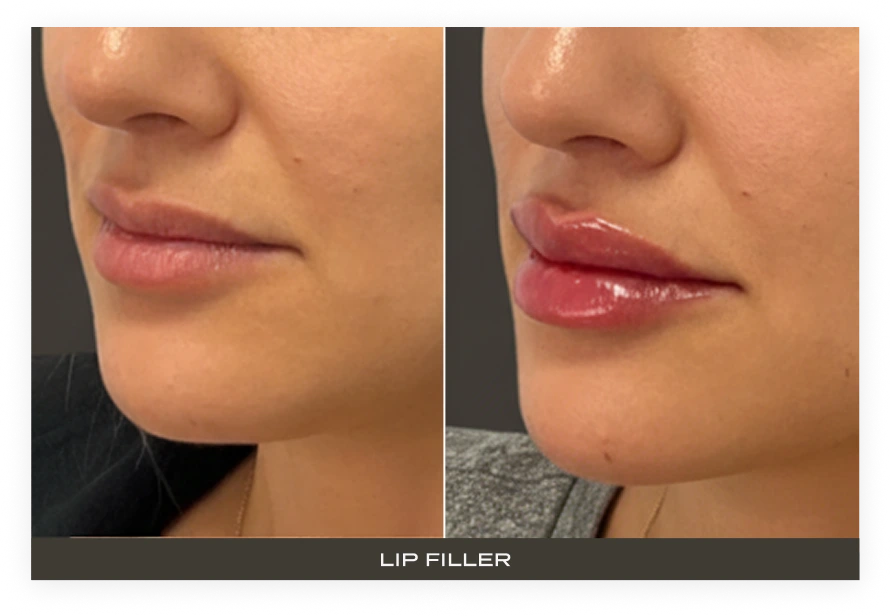 Before and after close-up comparison of lips showing fuller volume after lip filler treatment