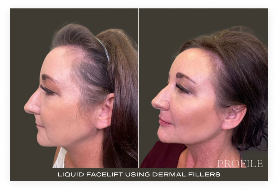 Before and after profile views showing liquid facelift with dermal fillers enhancing facial contours