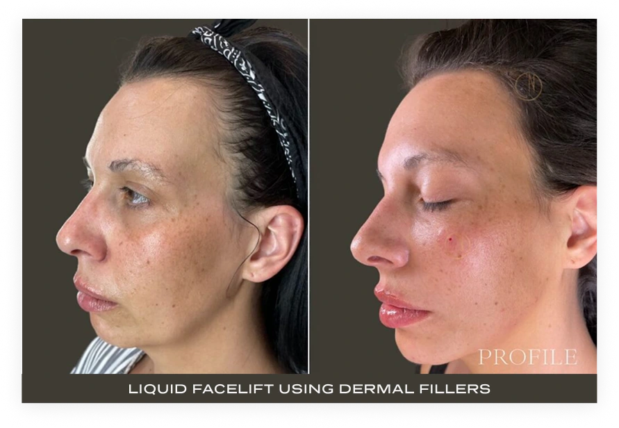 Before and after profile views showing liquid facelift results with improved facial definition using dermal fillers