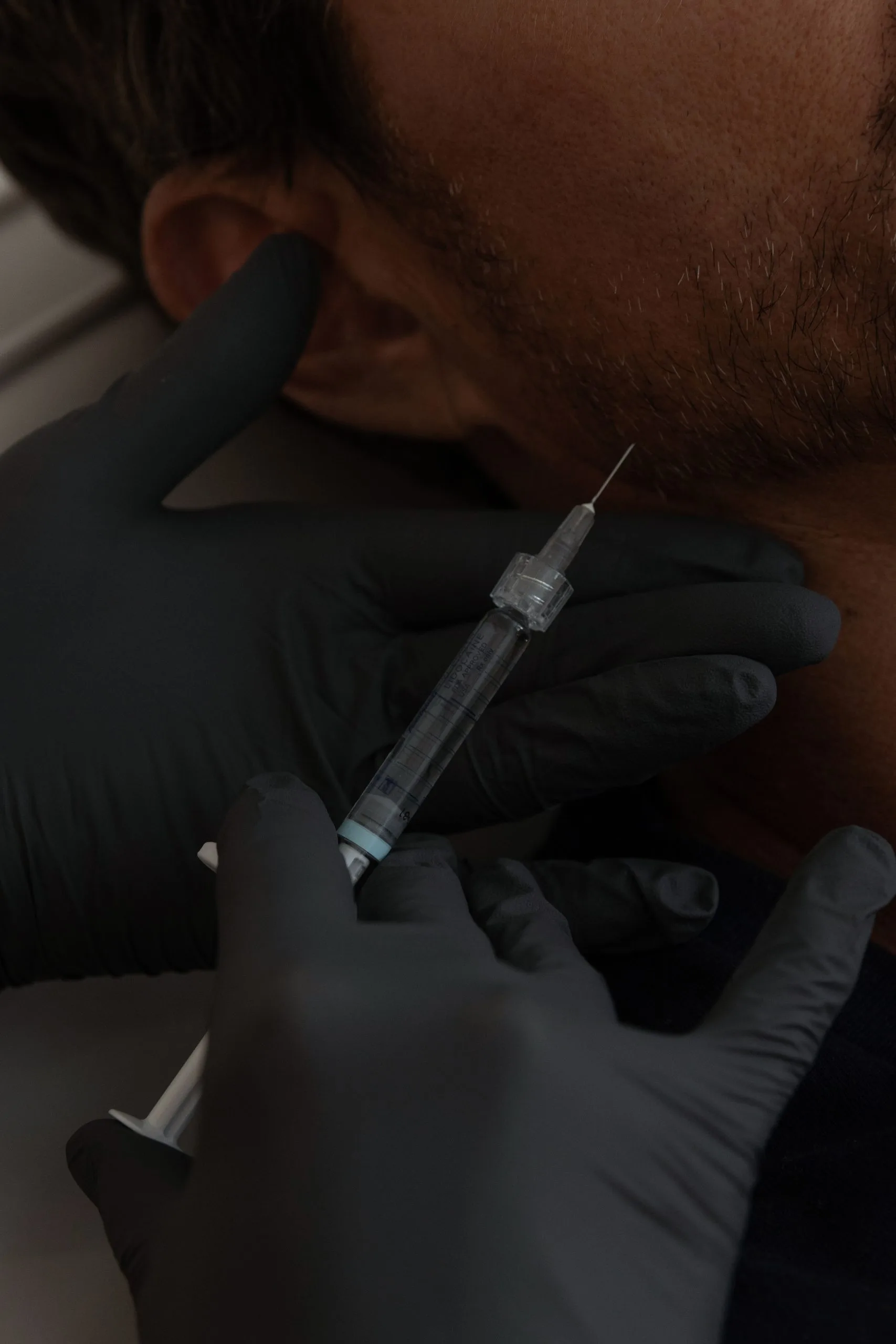Gloved hands holding syringe with needle tip visible during aesthetic procedure