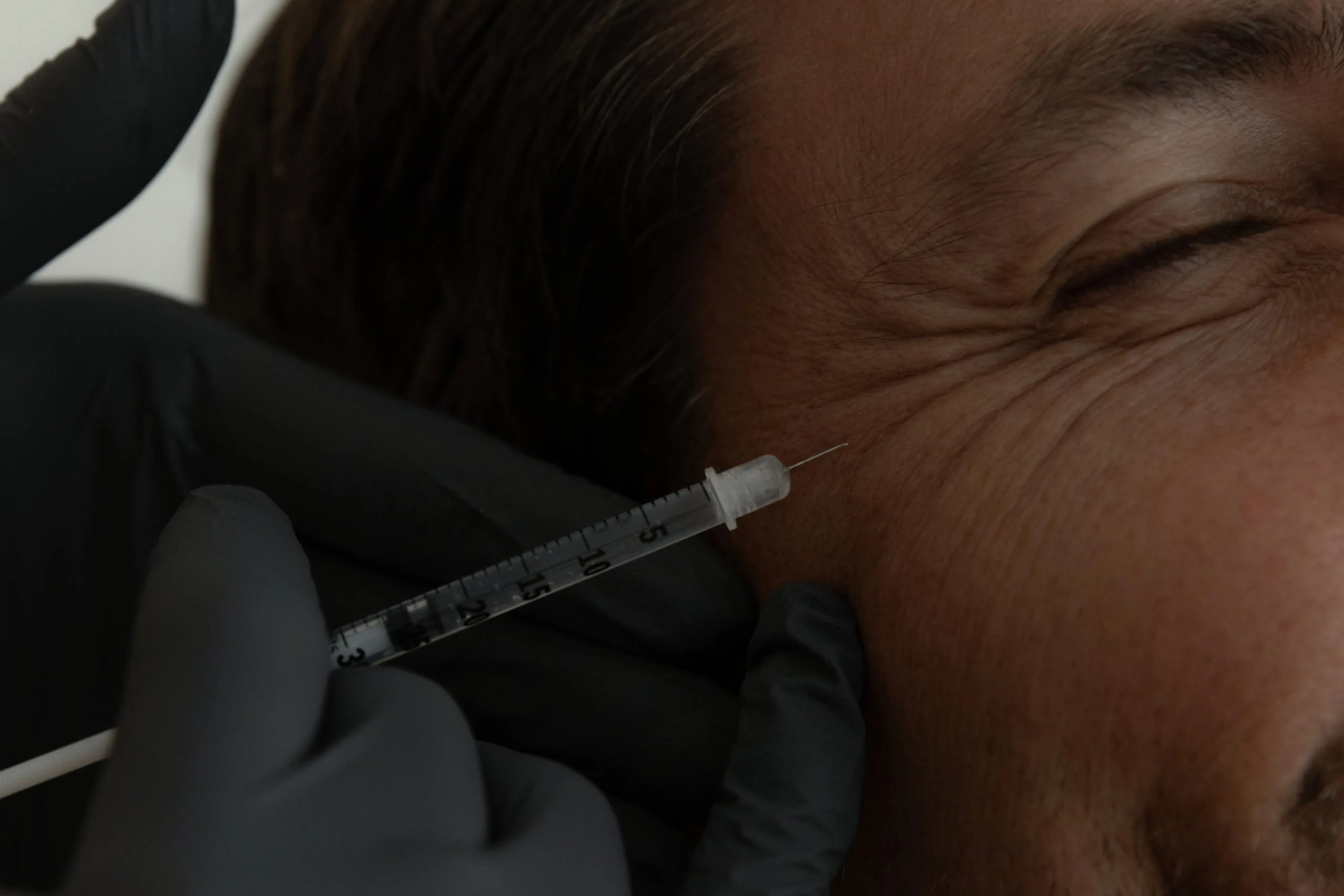 Practitioner injecting filler into patient's temple area near eye