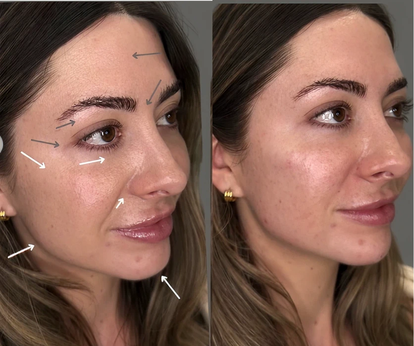Before-and-after comparison showing patient's face with forehead and under-eye areas marked with arrows indicating PRP treatment results