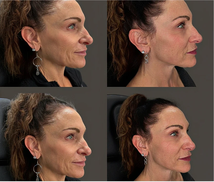 Four-panel before and after comparison of patient profile showing enhanced facial volume and contour from Sculptra and PRP