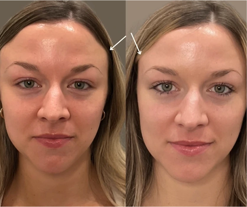 Before and after comparison of woman's forehead showing reduced frown lines, with arrows indicating treatment areas