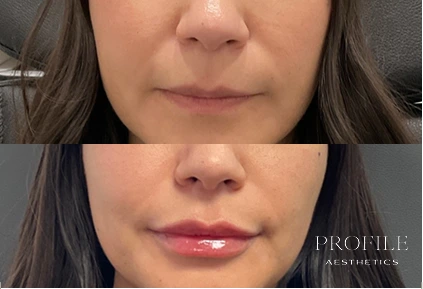 Before and after lip enhancement showing fuller lips with increased volume and definition