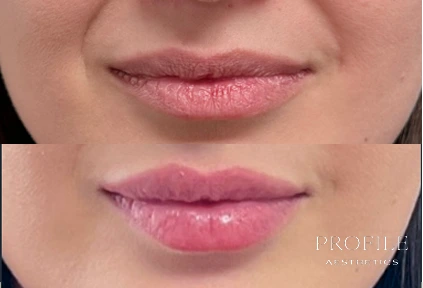 Before and after lip filler treatment showing fuller, more defined lips