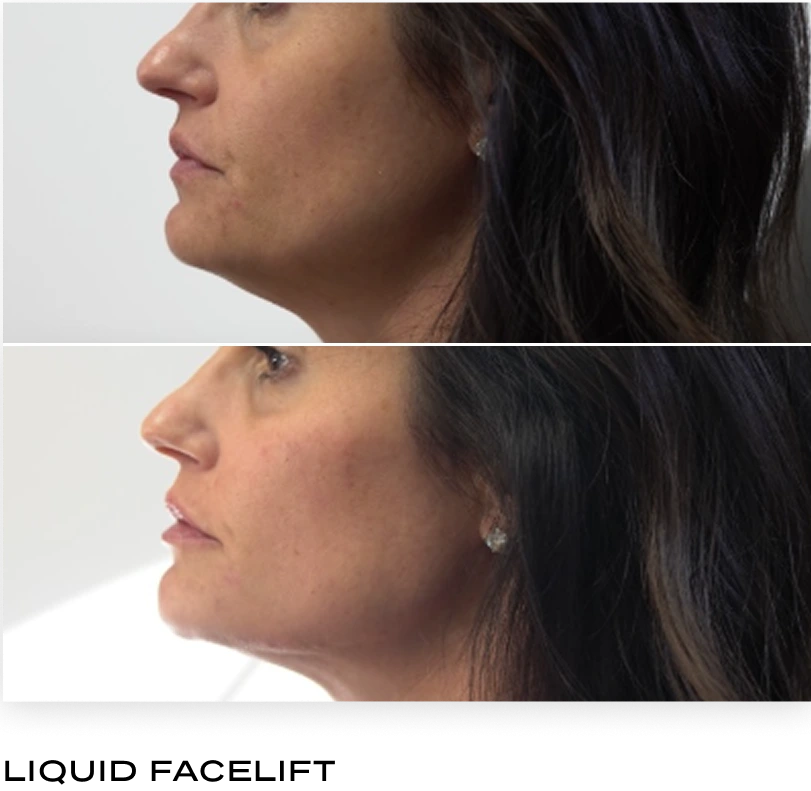 Liquid Facelift: side-by-side profile comparison showing facial contour enhancement results