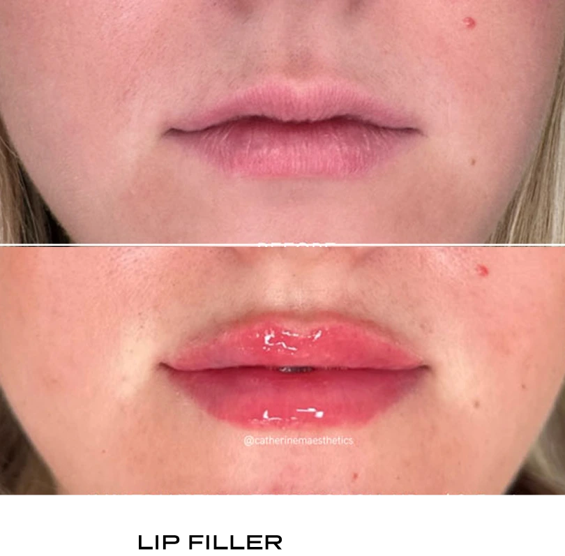 Before and after comparison of enhanced lips from lip filler procedure
